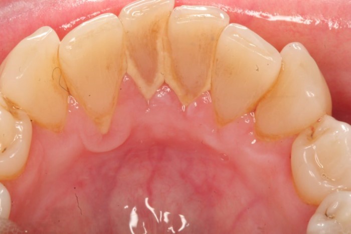 Những mảng bám trên răng gây ảnh hưởng nghiêm trọng đến sức khỏe răng miệng